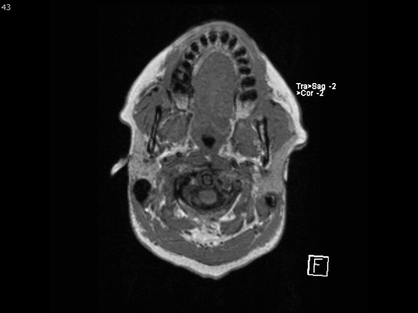 Atypical meningioma - intraosseous (Radiopaedia 64915-74572 Axial T1 43).jpg
