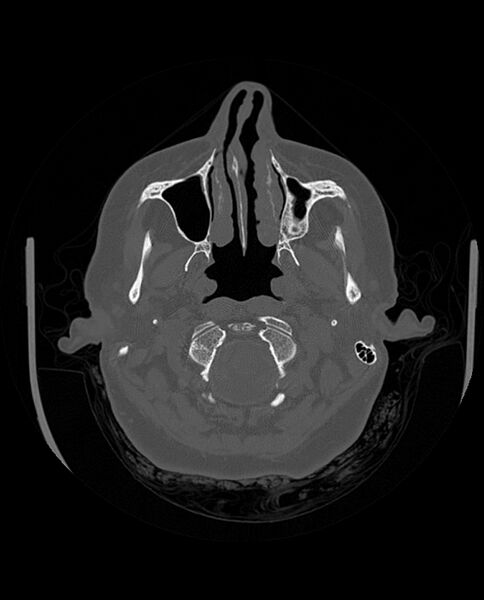 File:Automastoidectomy with labyrinthine fistula (Radiopaedia 84143-99411 Axial non-contrast 52).jpg
