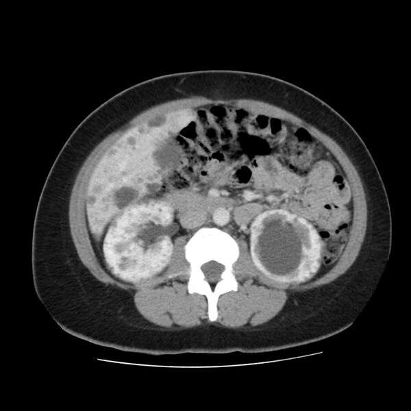 File:Autosomal dominant polycystic kidney disease (Radiopaedia 23061-23093 C 31).jpg
