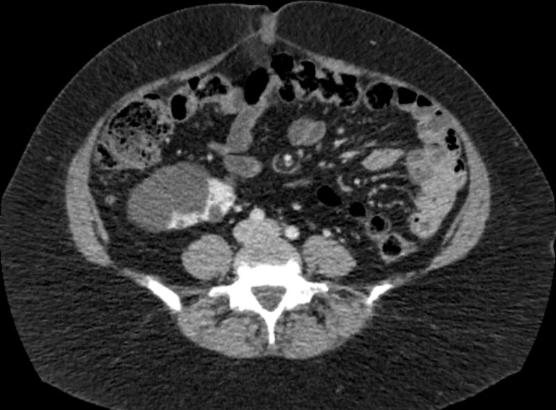 File:Autosomal dominant polycystic kidney disease (Radiopaedia 57124-64017 A 73).jpg