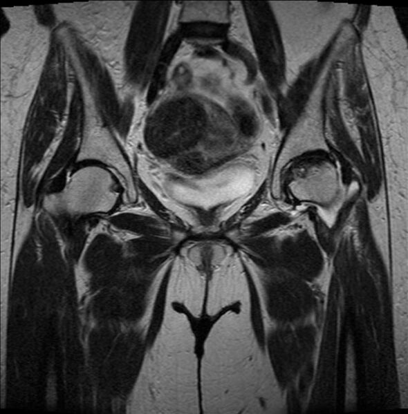 File:Avascular necrosis of the femoral head (Radiopaedia 7579).jpg