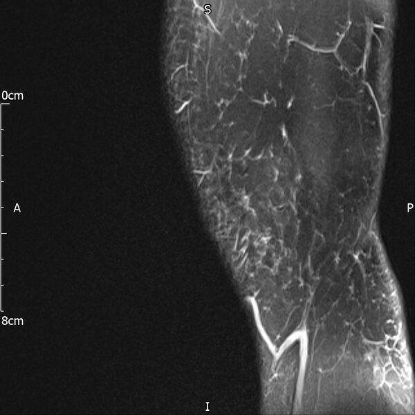 File:Avulsion fracture of the fibular head (Radiopaedia 74804-85808 Sagittal PD fat sat 3).jpg