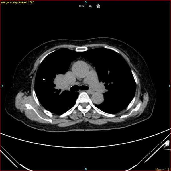 File:Azygos vein aneurysm (Radiopaedia 77824-90130 A 26).jpg