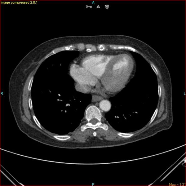 File:Azygos vein aneurysm (Radiopaedia 77824-90130 B 40).jpg