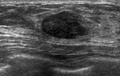 BIRADS IV lesion (Radiopaedia 18957).png
