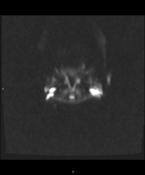 File:Basal ganglia and parenchymal ischemia (Radiopaedia 45818-50084 Axial DWI 2).jpg