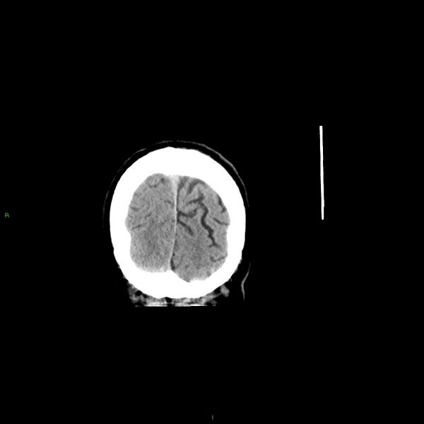 File:Basal ganglia hemorrhage (Radiopaedia 58348-65471 Coronal non-contrast 11).jpg