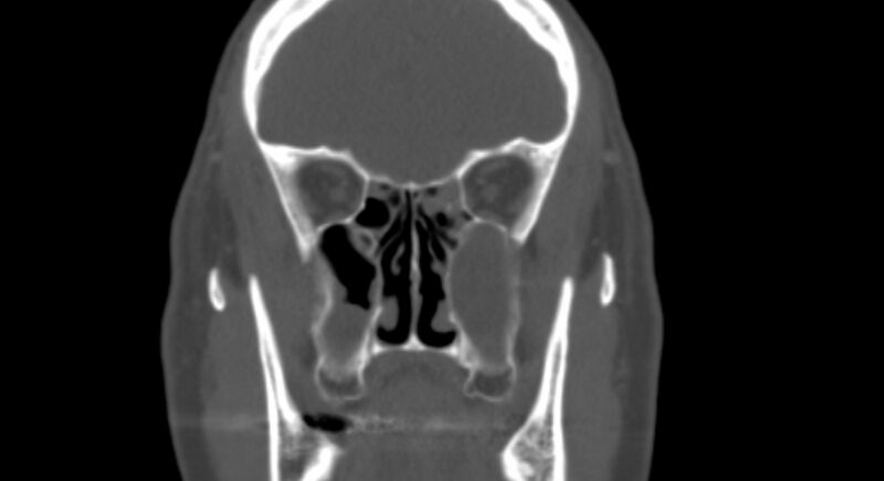 File:Benign mixed salivary tumor of the parotid gland (Radiopaedia 35261-36792 Coronal bone window 8).jpg