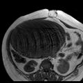 Benign seromucinous cystadenoma of the ovary (Radiopaedia 71065-81300 Axial T1 28).jpg