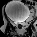 Benign seromucinous cystadenoma of the ovary (Radiopaedia 71065-81300 F 11).jpg