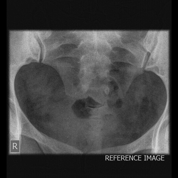 File:Bicornuate-septate uterus (Radiopaedia 59888-67354 A 1).JPEG