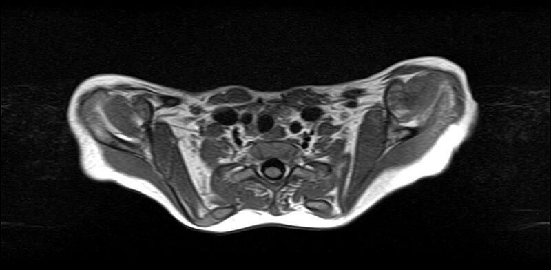 File:Bilateral Sprengel deformity with Klippel-Feil syndrome (Radiopaedia 66395-75650 Axial T1 19).jpg