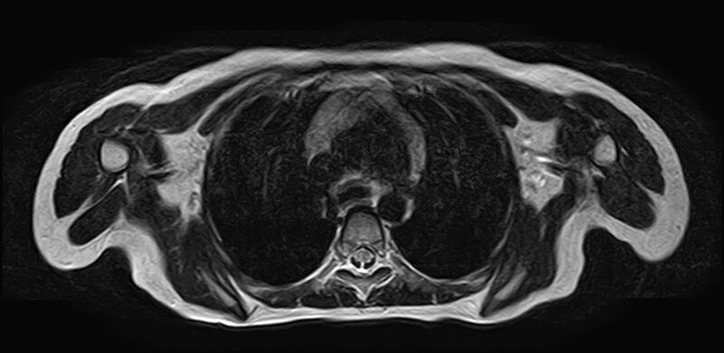 File:Bilateral Sprengel deformity with Klippel-Feil syndrome (Radiopaedia 66395-75650 Axial T2 28).jpg