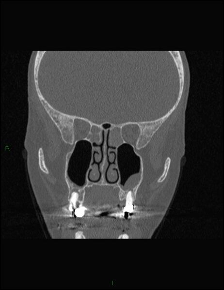 File:Bilateral frontal mucoceles (Radiopaedia 82352-96454 Coronal 166).jpg