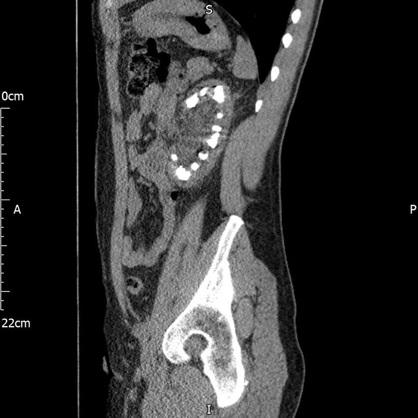 Bilateral medullary nephrocalcinosis with ureteric calculi (Radiopaedia 71269-81569 C 38).jpg