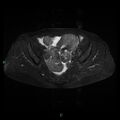 Bilateral ovarian fibroma (Radiopaedia 44568-48293 Axial STIR 13).jpg