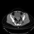 Bilateral ovarian mature cystic teratomas (Radiopaedia 79373-92457 Axial non-contrast 64).jpg