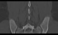 Bilateral pars defect (Radiopaedia 26691-26846 Coronal bone window 38).jpg