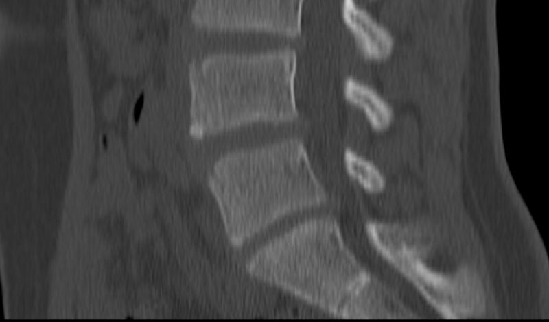 File:Bilateral pars defect (Radiopaedia 26691-26846 Sagittal bone window 29).jpg