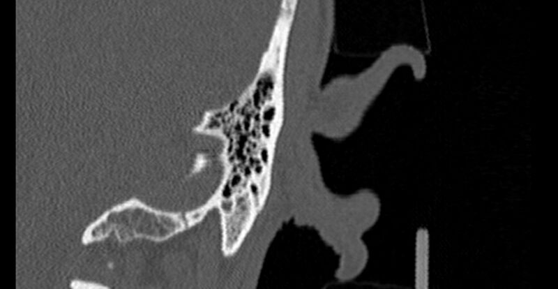 File:Bilateral temporal bone fractures (Radiopaedia 29482-29970 Coronal 284).jpg