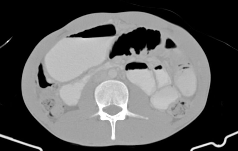File:Blunt injury to the small bowel (Radiopaedia 74953-85987 Axial Wide 42).jpg