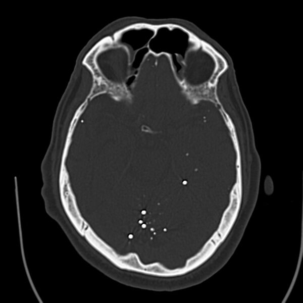 File:Brain Pantopaque remnants (Radiopaedia 78403-91048 Axial bone window 30).jpg
