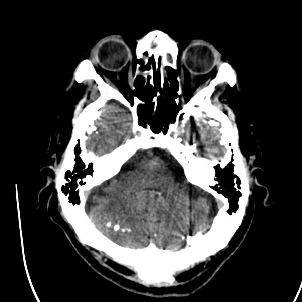 File:Brain Pantopaque remnants (Radiopaedia 78403-91048 Axial non-contrast 31).jpg