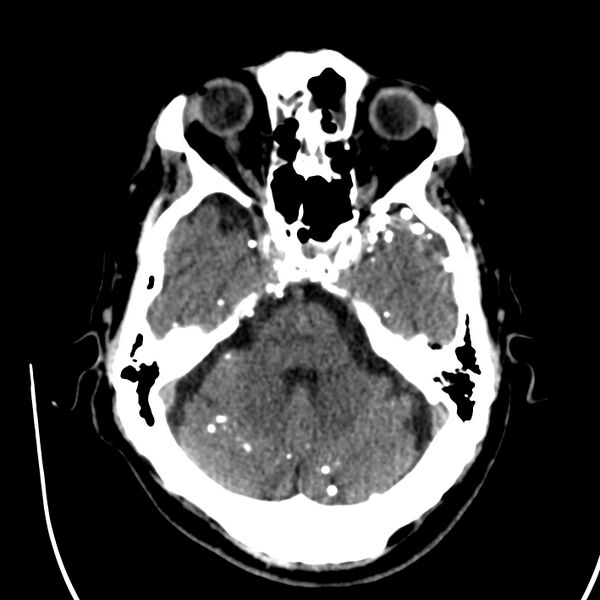 File:Brain Pantopaque remnants (Radiopaedia 78403-91048 Axial non-contrast 34).jpg