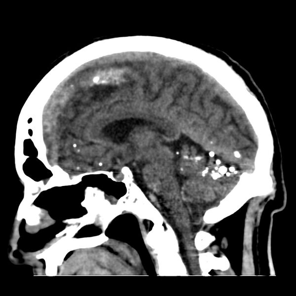 File:Brain Pantopaque remnants (Radiopaedia 78403-91048 C 30).jpg