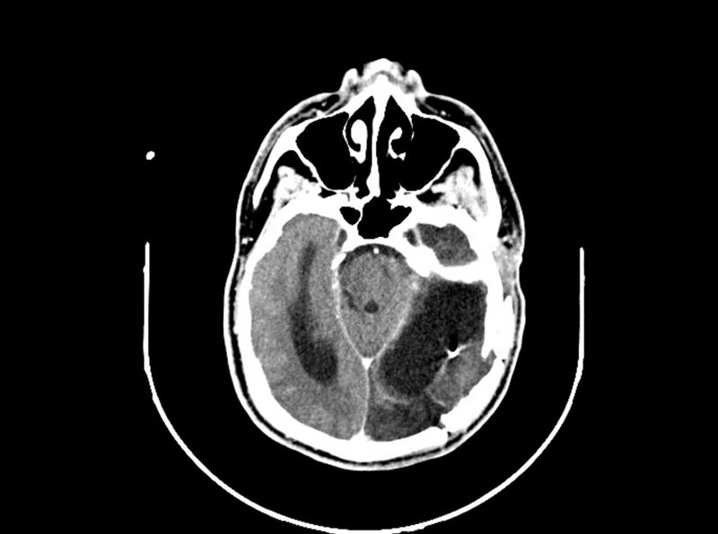 File:Brain injury by firearm projectile (Radiopaedia 82068-96088 B 102).jpg