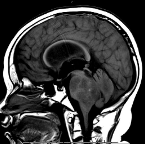 File:Brainstem glioma (Radiopaedia 6524-7839 Sagittal T1 1).jpg