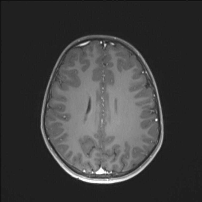 Brainstem glioma (Radiopaedia 70548-80674 Axial T1 C+ 105).jpg