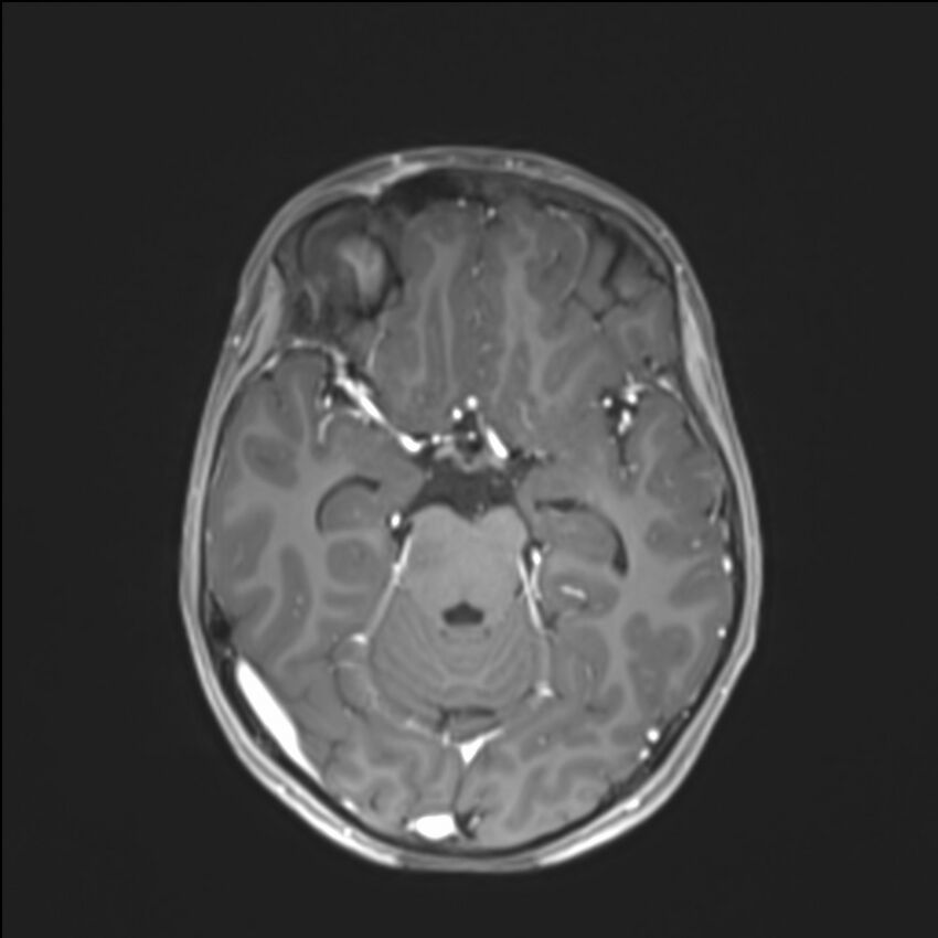 Brainstem glioma (Radiopaedia 70548-80674 Axial T1 C+ 66).jpg