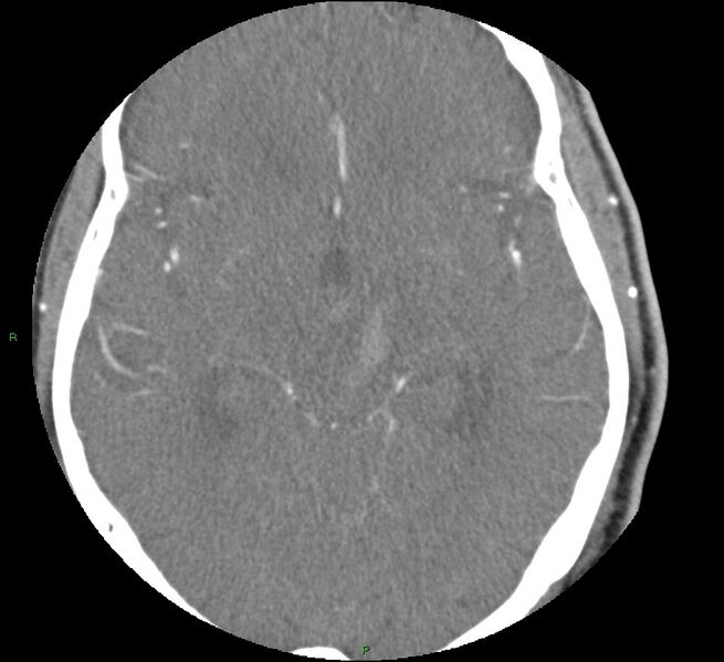 File:Brainstem hemorrhage (Radiopaedia 58794-66028 D 88).jpg