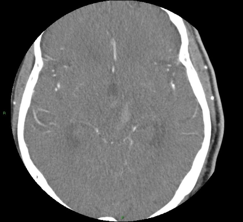 Brainstem hemorrhage (Radiopaedia 58794-66028 D 88).jpg