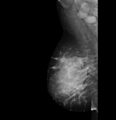 Breast abscess (Radiopaedia 72586-83138 R MLO 1).PNG