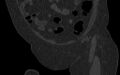 Breast carcinoma with pathological hip fracture (Radiopaedia 60314-67993 Coronal bone window 42).jpg