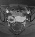 Broad ligament leiomyoma (Radiopaedia 81634-95516 Axial T1 C+ fat sat 13).jpg