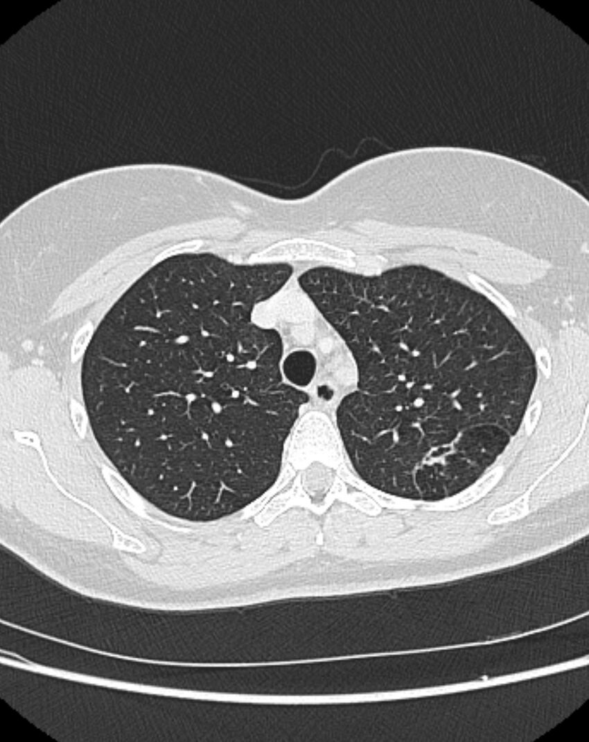 Bronchial atresia (Radiopaedia 50007-55297 Axial lung window 25).jpg