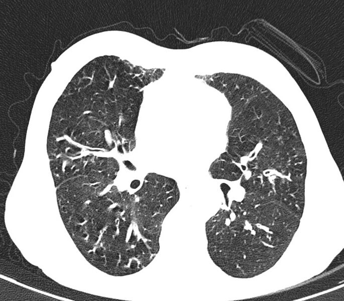 File:Bronchiolitis (Radiopaedia 24616-24887 Axial lung window 29).jpg