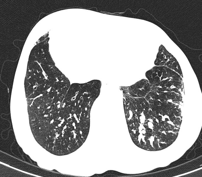 File:Bronchiolitis (Radiopaedia 24616-24887 Axial lung window 49).jpg