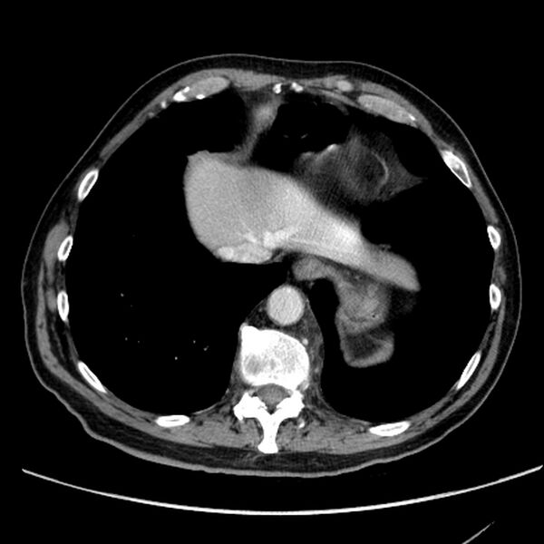 File:Bronchogenic carcinoma with L1 vertebra metastasis (Radiopaedia 9096-9805 Axial C+ delayed 28).jpg