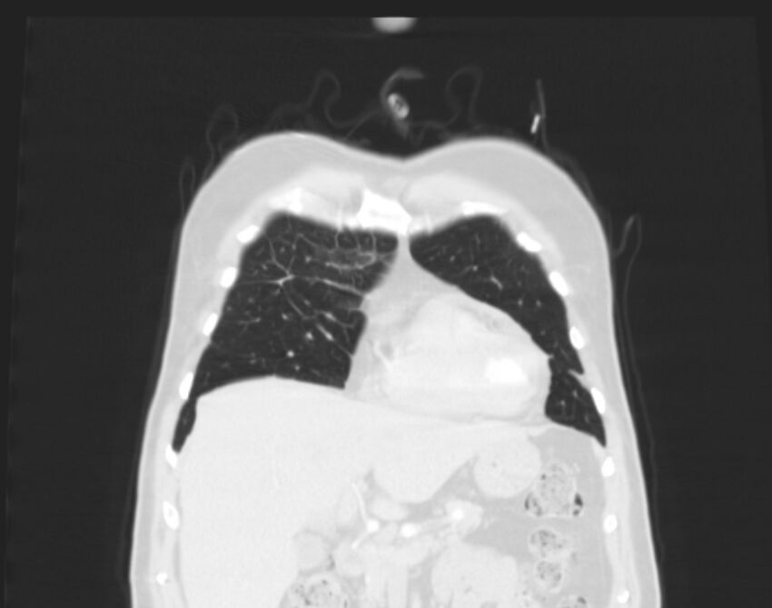 Bronchogenic carcinoma with lymphangitic spread (Radiopaedia 29002-29357 Coronal lung window 10).jpg