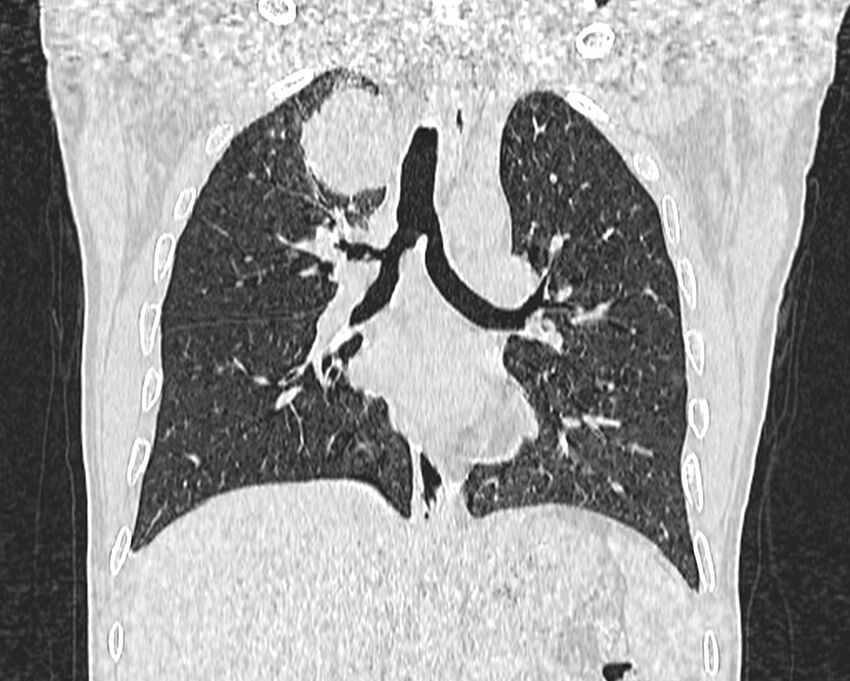 Bronchogenic carcinoma with superior vena cava syndrome (Radiopaedia 36497-38054 Coronal lung window 45).jpg