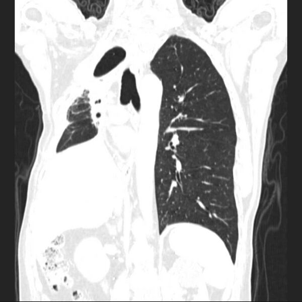 File:Bronchopleural fistula - postoperative complication (Radiopaedia 21020-20947 Coronal lung window 17).jpg