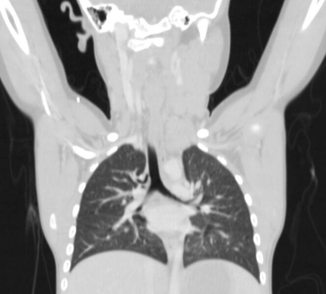 File:Bronchus suis (Radiopaedia 68131-77620 Coronal lung window 10).jpg