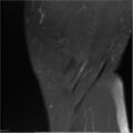Bucket handle tear - lateral meniscus (Radiopaedia 7246-8187 Sagittal T2 fat sat 23).jpg