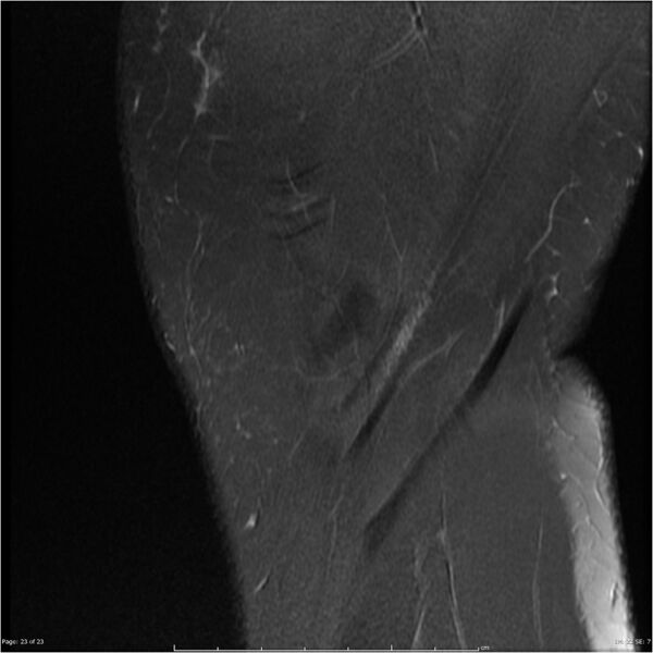 File:Bucket handle tear - lateral meniscus (Radiopaedia 7246-8187 Sagittal T2 fat sat 23).jpg