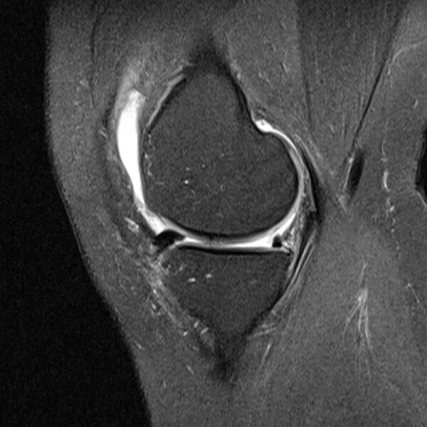 File:Bucket handle tear - medial meniscus (Radiopaedia 79028-91942 Sagittal PD fat sat 18).jpg