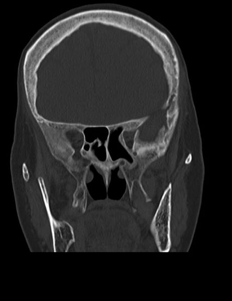 File:Burnt-out meningioma (Radiopaedia 51557-57337 Coronal bone window 16).jpg